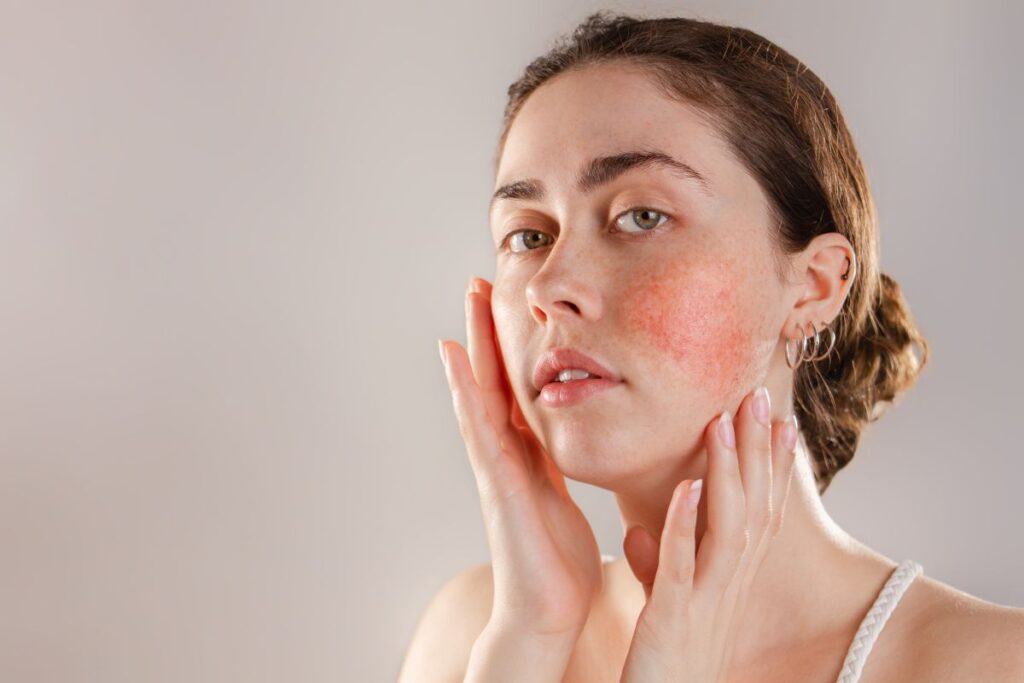 A woman gently touching her face, highlighting visible skin redness and irritation on her cheeks.