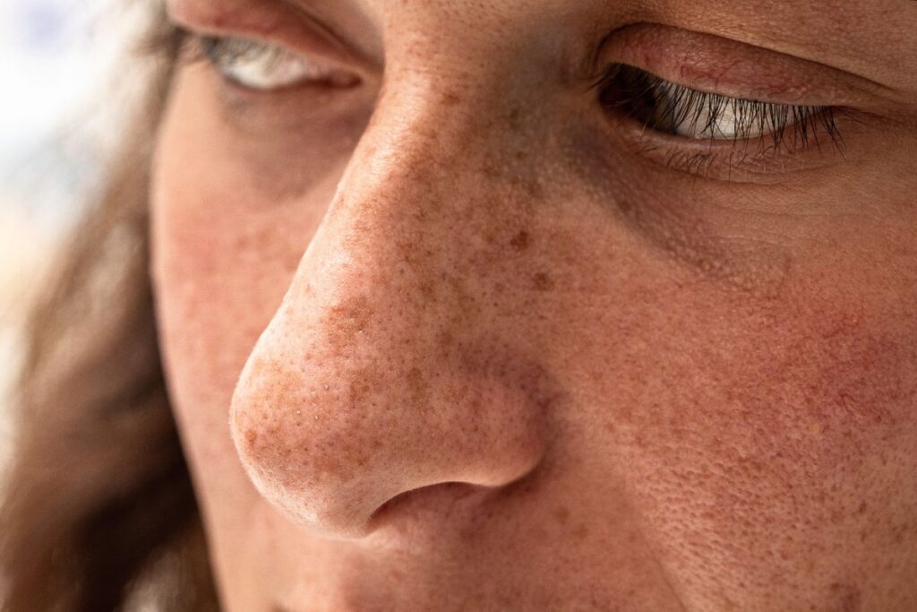 Close-up of a woman's face showing freckles, discoloration, and redness caused by sun damage.