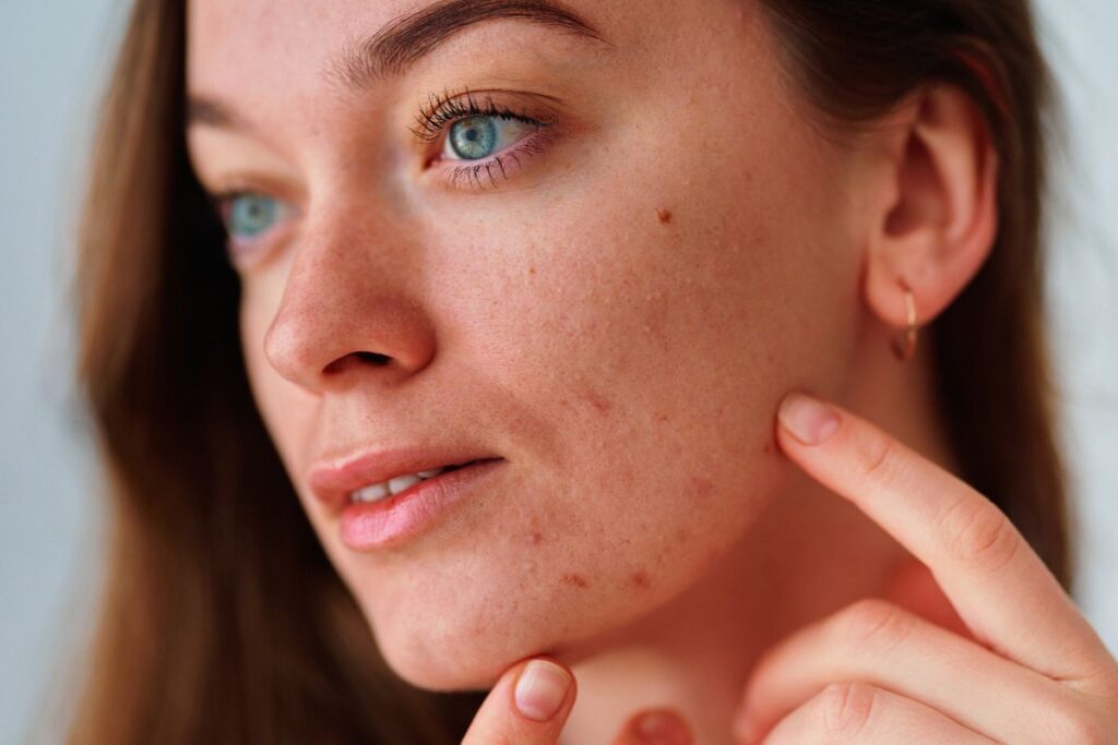 Close-up of a woman pointing to acne scars and blemishes on her cheek, highlighting skin concerns.