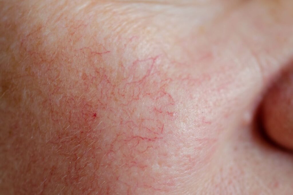 Close-up of facial skin showing vascular lesions with visible red veins and capillaries.