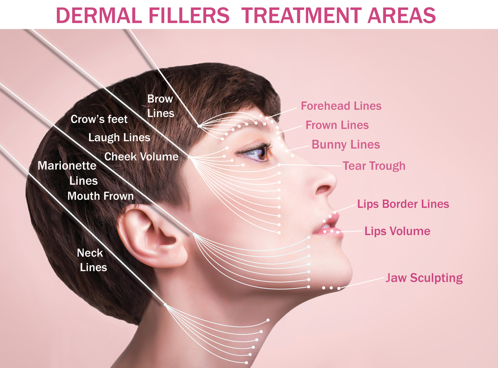 Illustration showcasing key facial zones treated with dermal fillers for enhanced volume and contour.