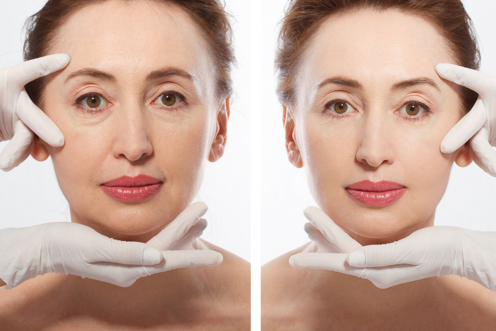 Side-by-side comparison showing facial improvements achieved with dermal fillers.