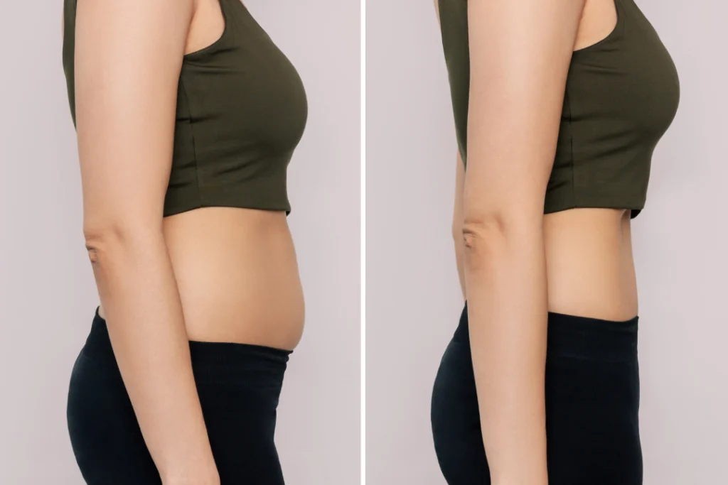 Side-by-side comparison showcasing Emsculpt results for a toned and slimmer abdomen.