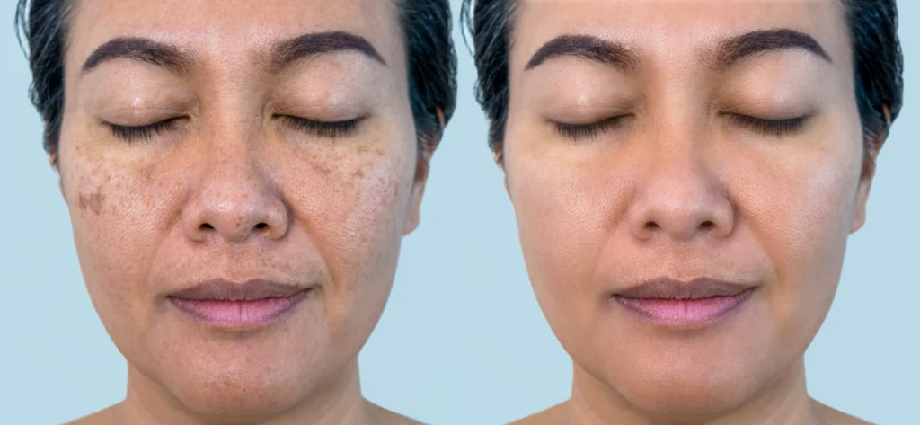 A before-and-after comparison of a woman's skin showing improved complexion and reduced blemishes after Hydrafacials.