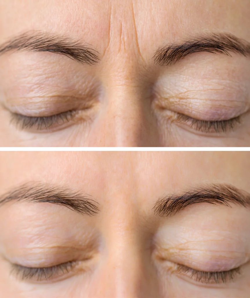 Before and after results of wrinkle treatment with injectables